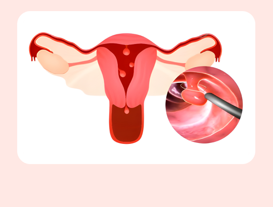 Полипы эндометрия: новая информация для специалистов